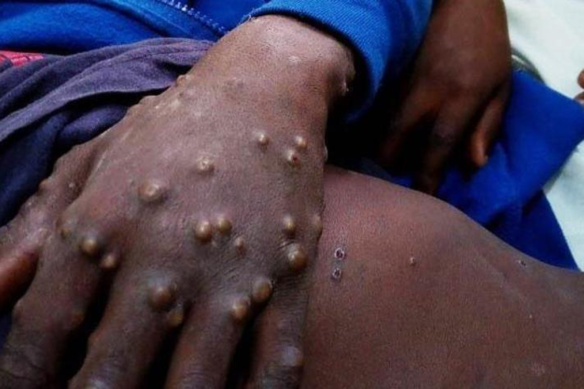 Maniema : près de 205 cas de Monkey Pox et 2 décès enregistré en 8 mois