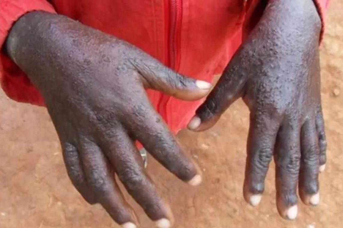 Nord-Kivu : la population appelée à la prudence face à la fièvre charbonneuse
